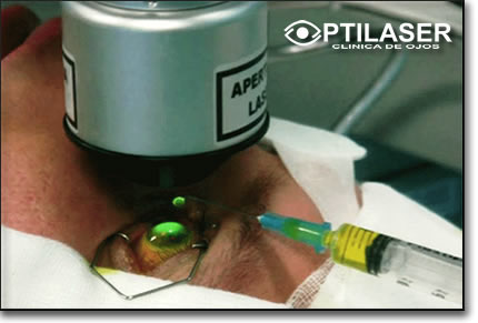 Clinica de ojos Optilaser - Linking corneal
